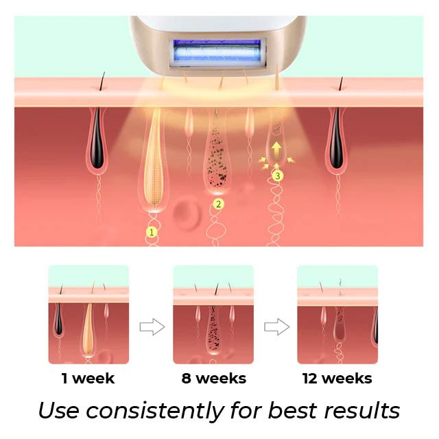 IPL Laser Hair Removal Device - Austier